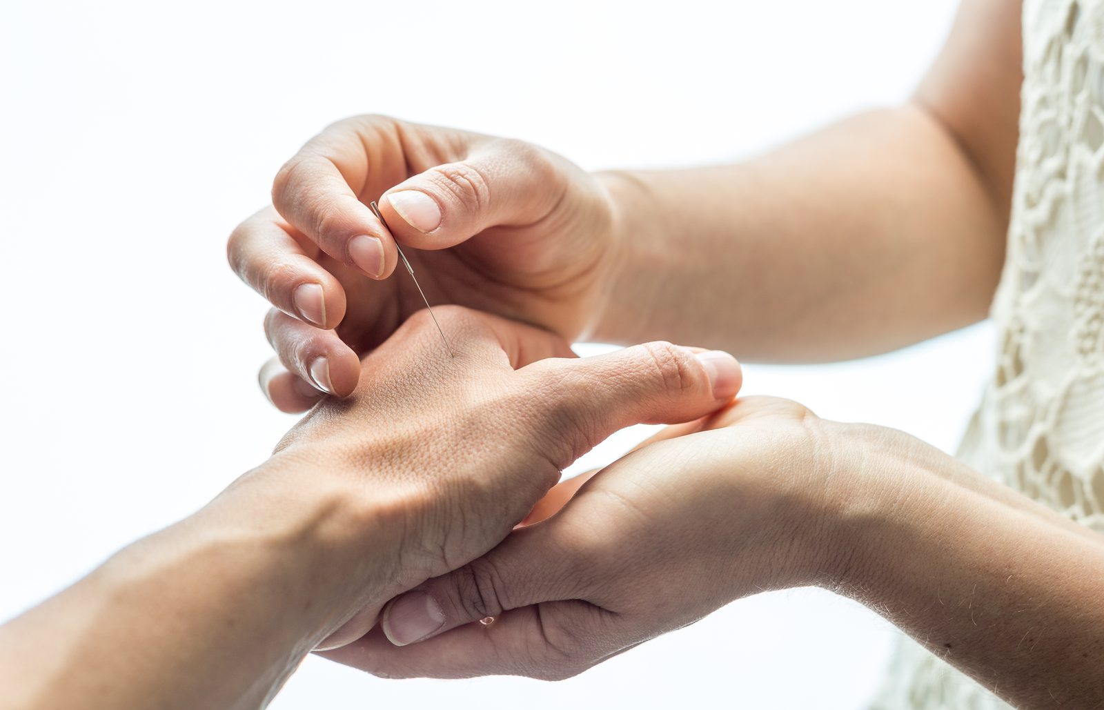 Acupuncture being performed on a patient's hand